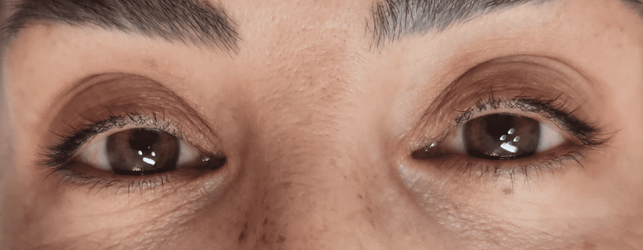 Paciente recibiendo tratamiento de ojos