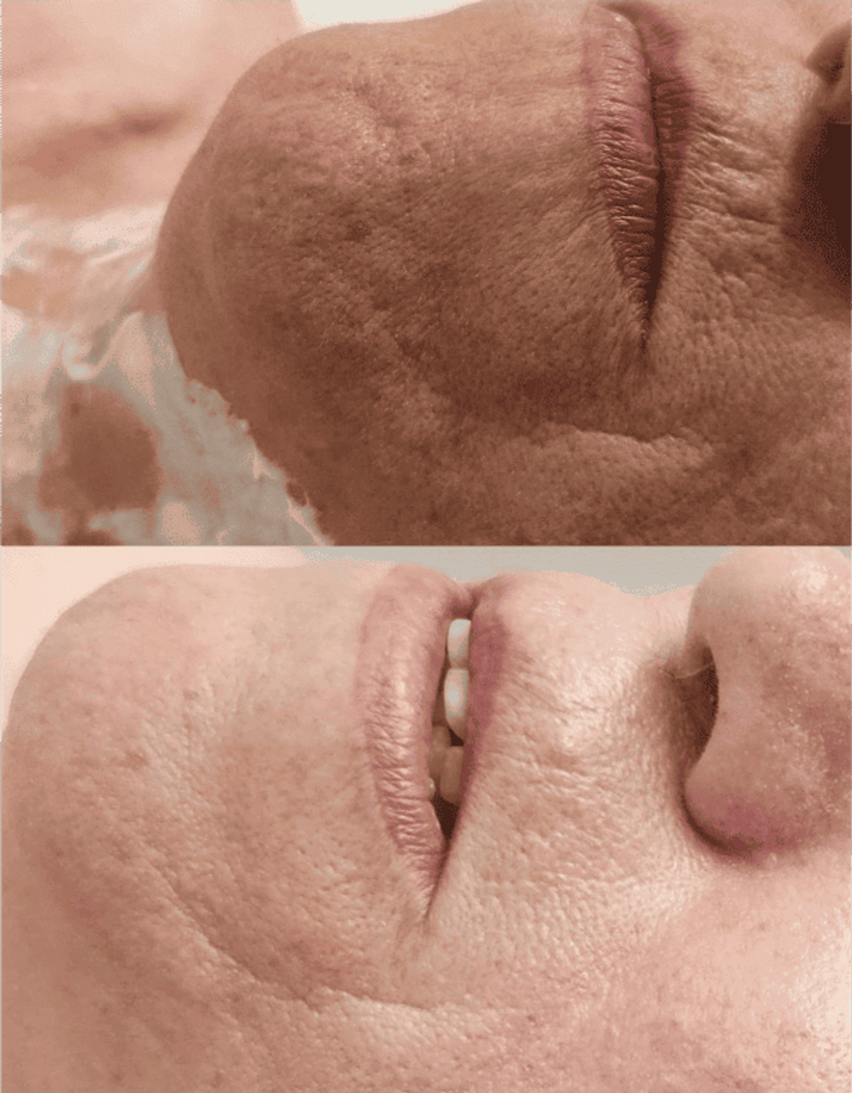 Antes y después de tratamientos faciales 2