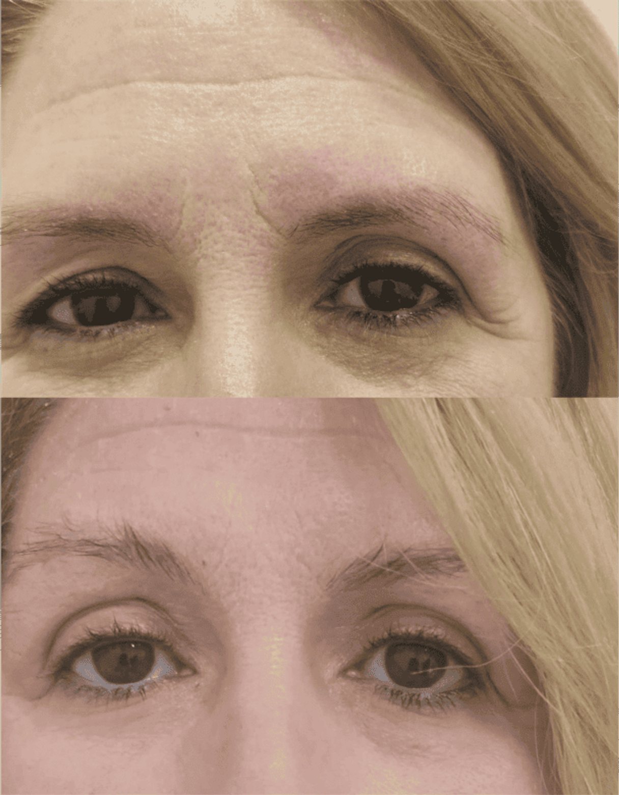 Antes y después de tratamientos faciales 3