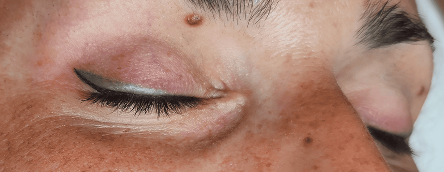 Tratamiento de ojos en consulta