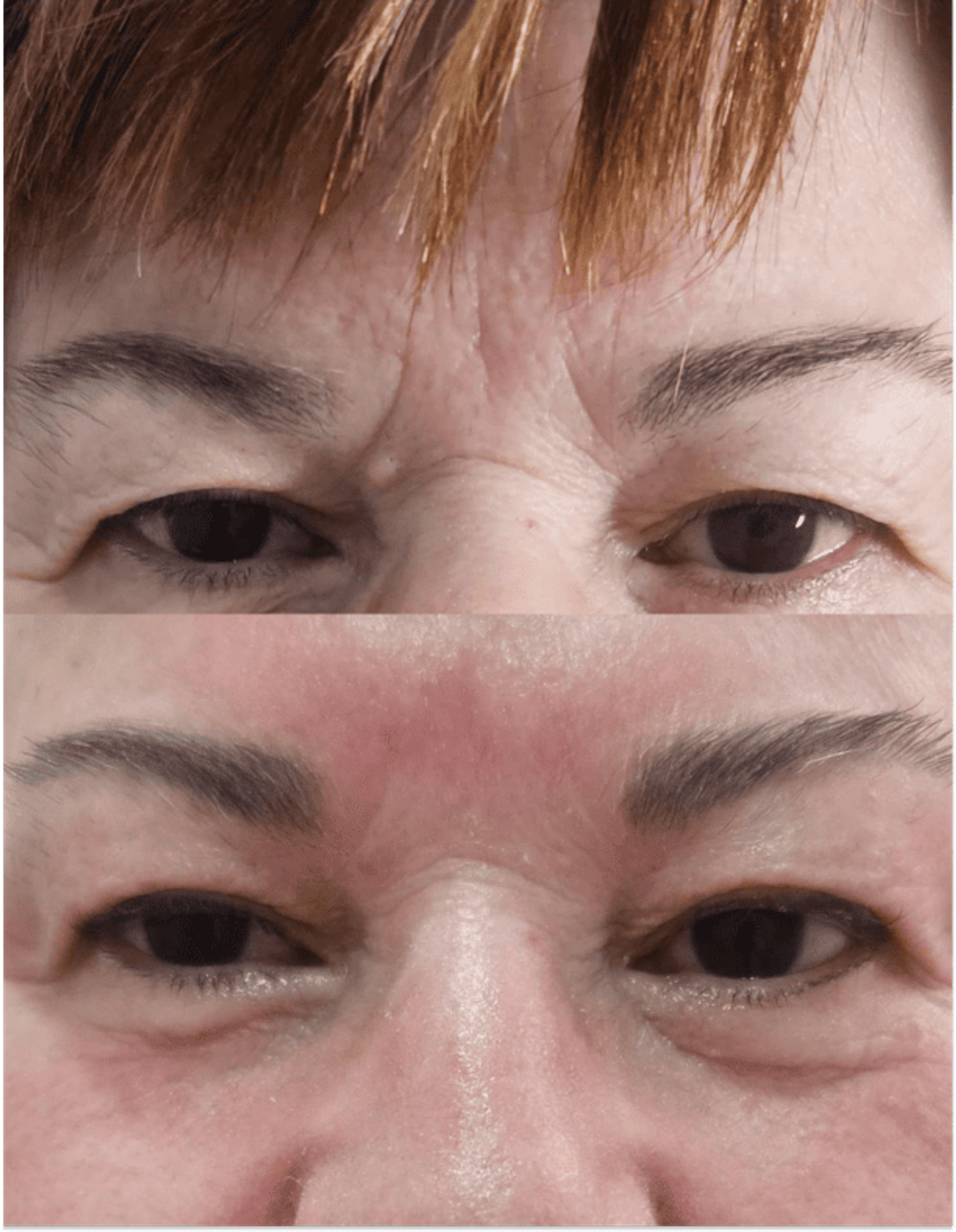 Antes y después de tratamientos faciales 4