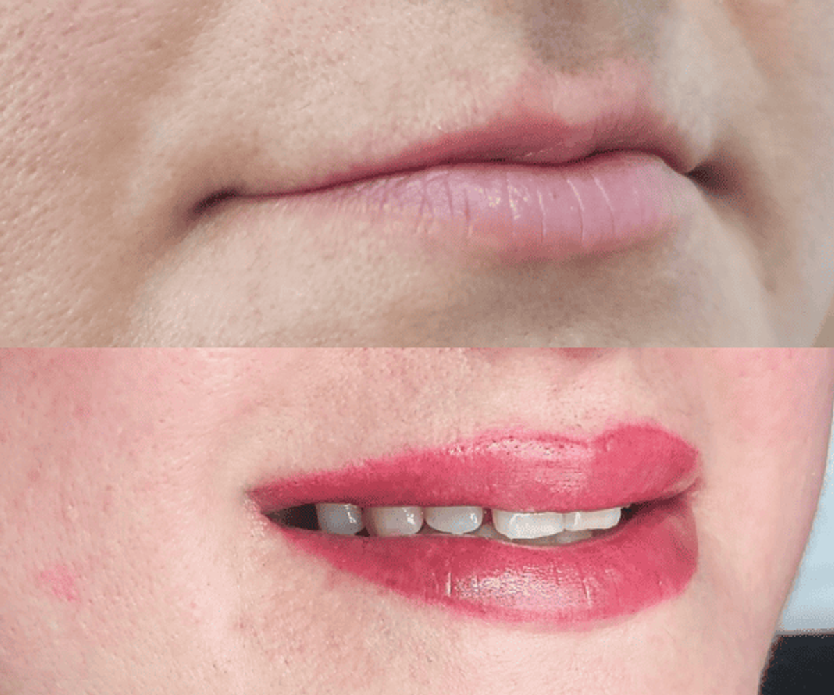 Antes y después de micropigmentación de labios - Caso 4
