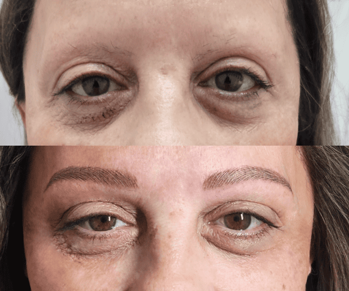 Antes de la tratamientos de cejas 5