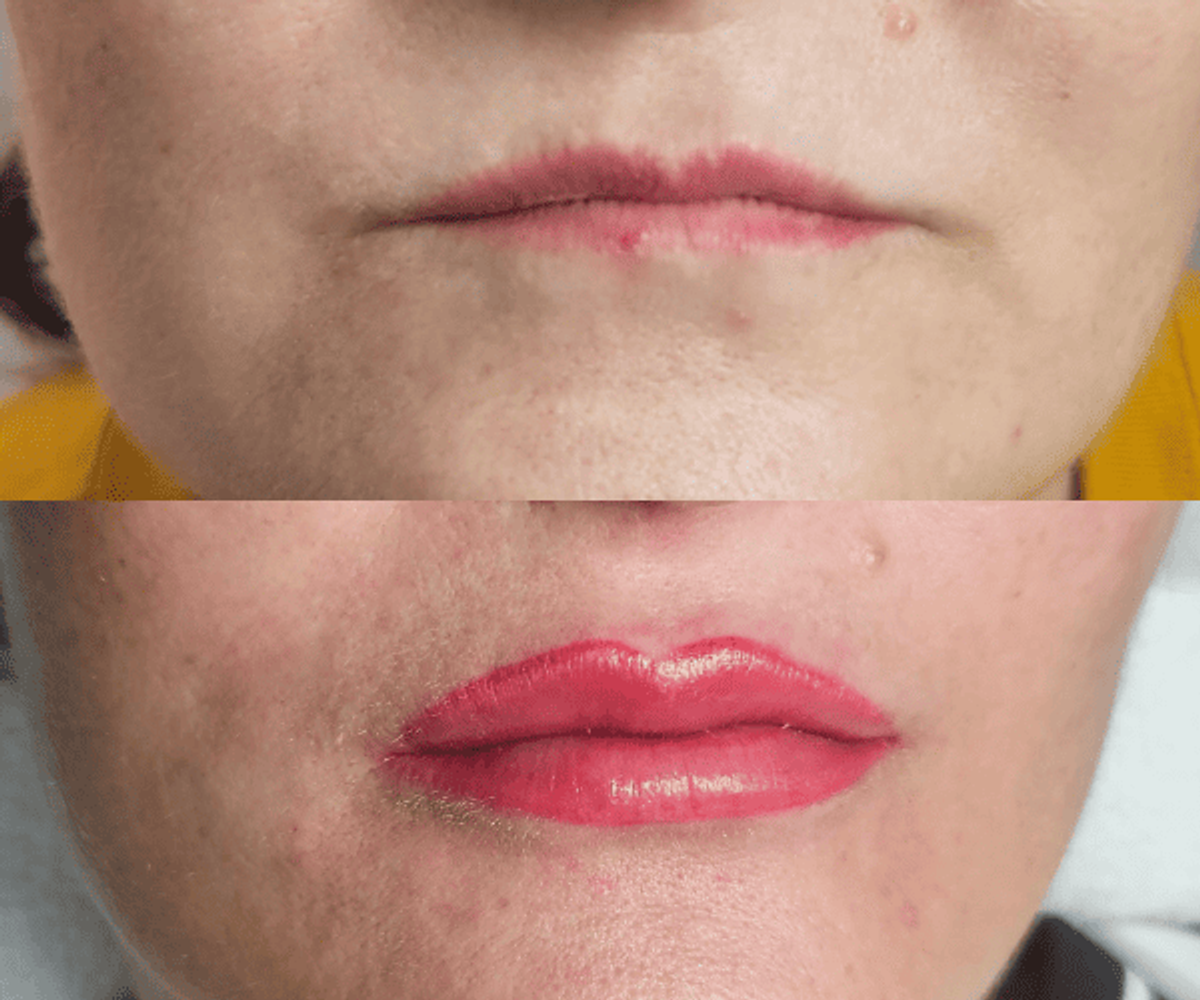 Antes y después de micropigmentación de labios - Caso 5