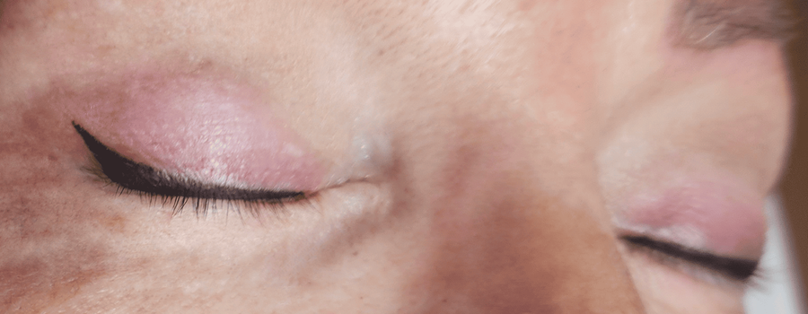 Lente utilizada en tratamiento de ojos