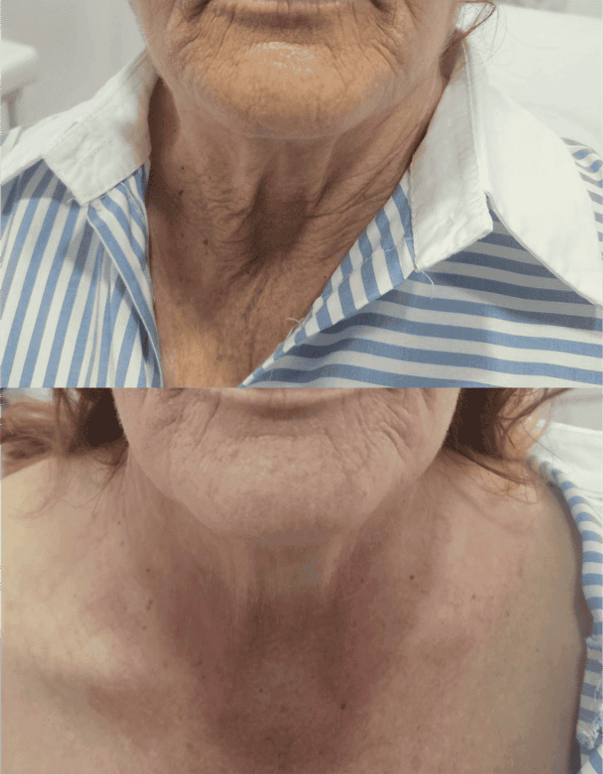 Antes y después de tratamientos faciales 6