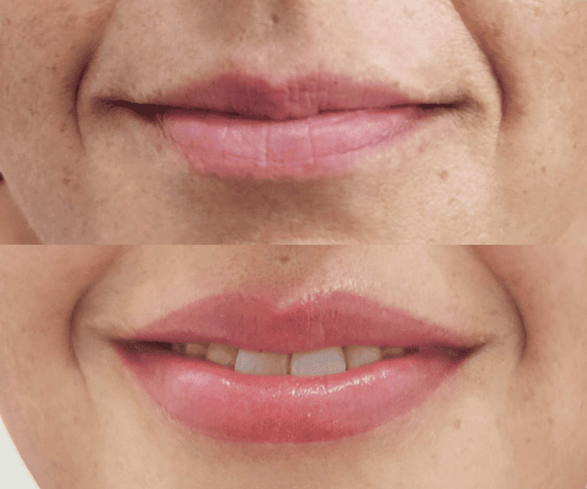 Antes y después de micropigmentación de labios - Caso 6