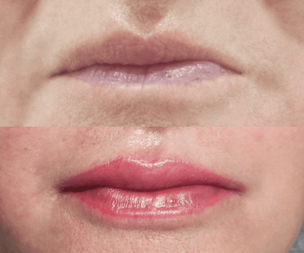 Antes y después de micropigmentación de labios - Caso 7
