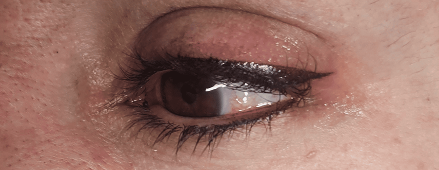 Resultados finales del tratamiento de ojos