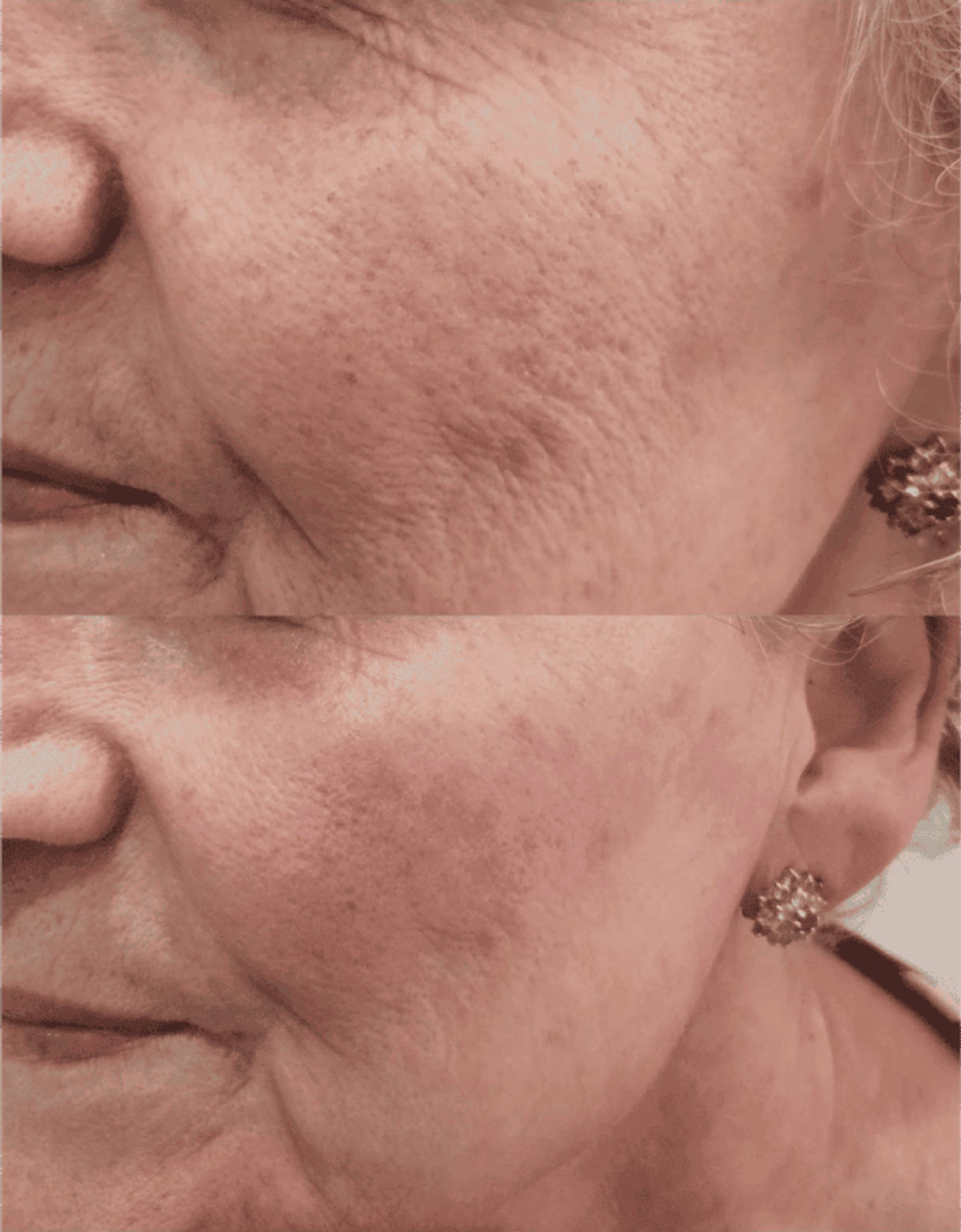 Antes y después de tratamientos faciales 8