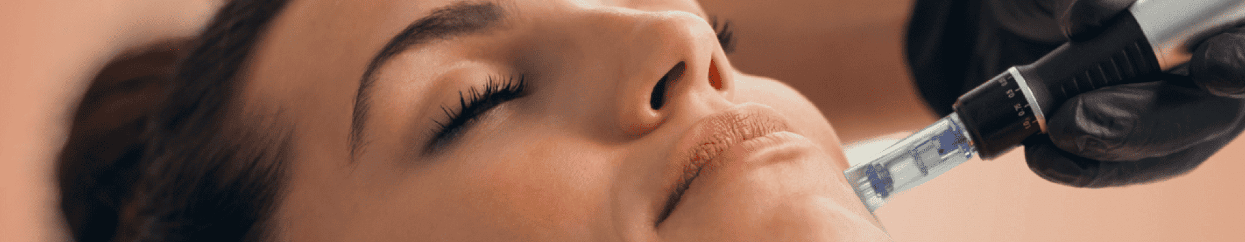 Tratamiento Dermapen Facial